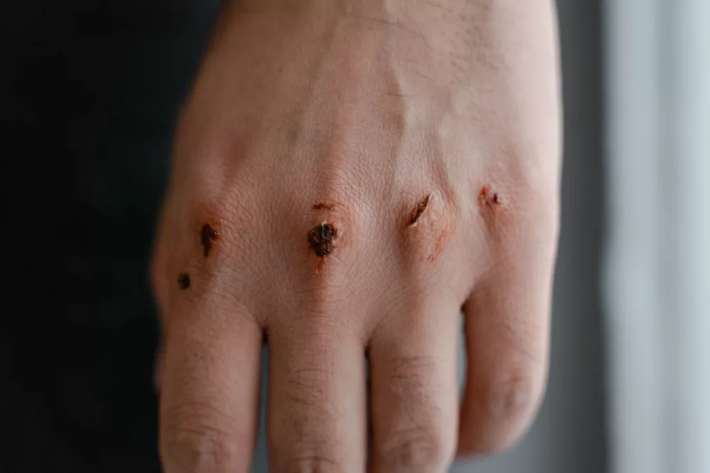 Understanding Macerated Skin: Causes, Prevention, and Treatment